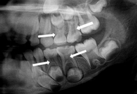 radiograph of pulp stones