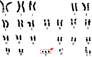 Hemophilia Karyotype Chart