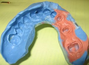 Photo of dental impression mold made at a dentist's office.