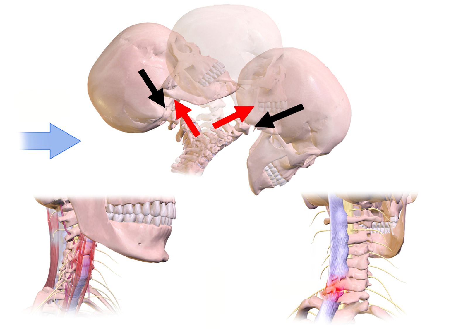 First image: The spine in a near vertical position while the head is moving from an extreme rearward position forward to a face-down position. Force pairs of equal length and opposite direction shown the force of the neck on the head and head back on the neck. Second and third images: Regions of injury on the front of the neck (soft tissue) and back of the neck (soft tissue and spine) are highlighted.
