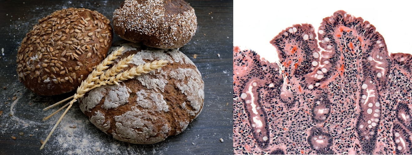 At left is a photo of 3 loaves of bread, with several stalks of dried wheat laid across their tops. At right is a section of a small intestine biopsy, shown magnified so that cells forming the villi are visible. Rather than being finger-like projections, the villi are blunted and short.