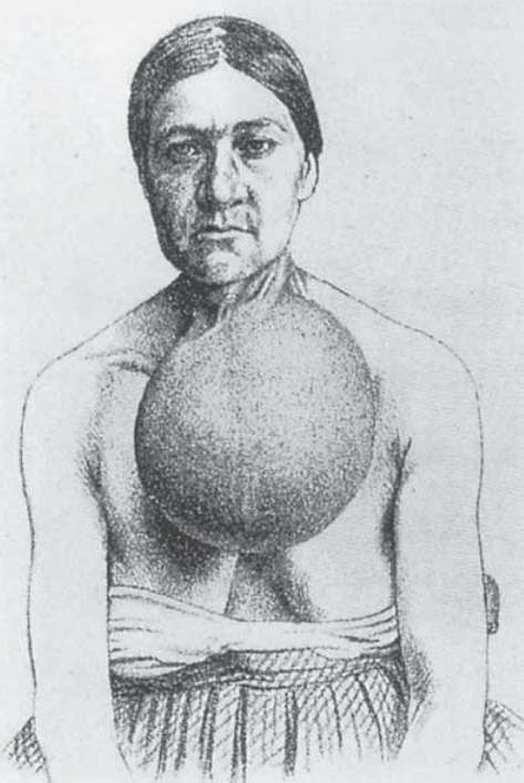 A picture of a woman with goiter. Her neck is swollen just below the chin to the size of a small melon.