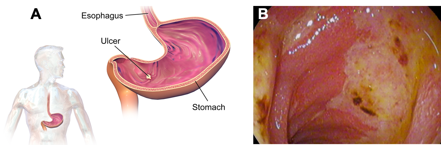 At left is a cartoon showing a profile of a person's torso, with the stomach and esophagus highlighted. Next to it is a larger version of the drawing of a stomach, with a yellow-colored ulcer shown on the stomach's lining. At right is an image from an endoscopy, showing the lining of the duodenum with abnormal lesions that are yellow, white, and brown in color compared to the normal pink tissue around it.