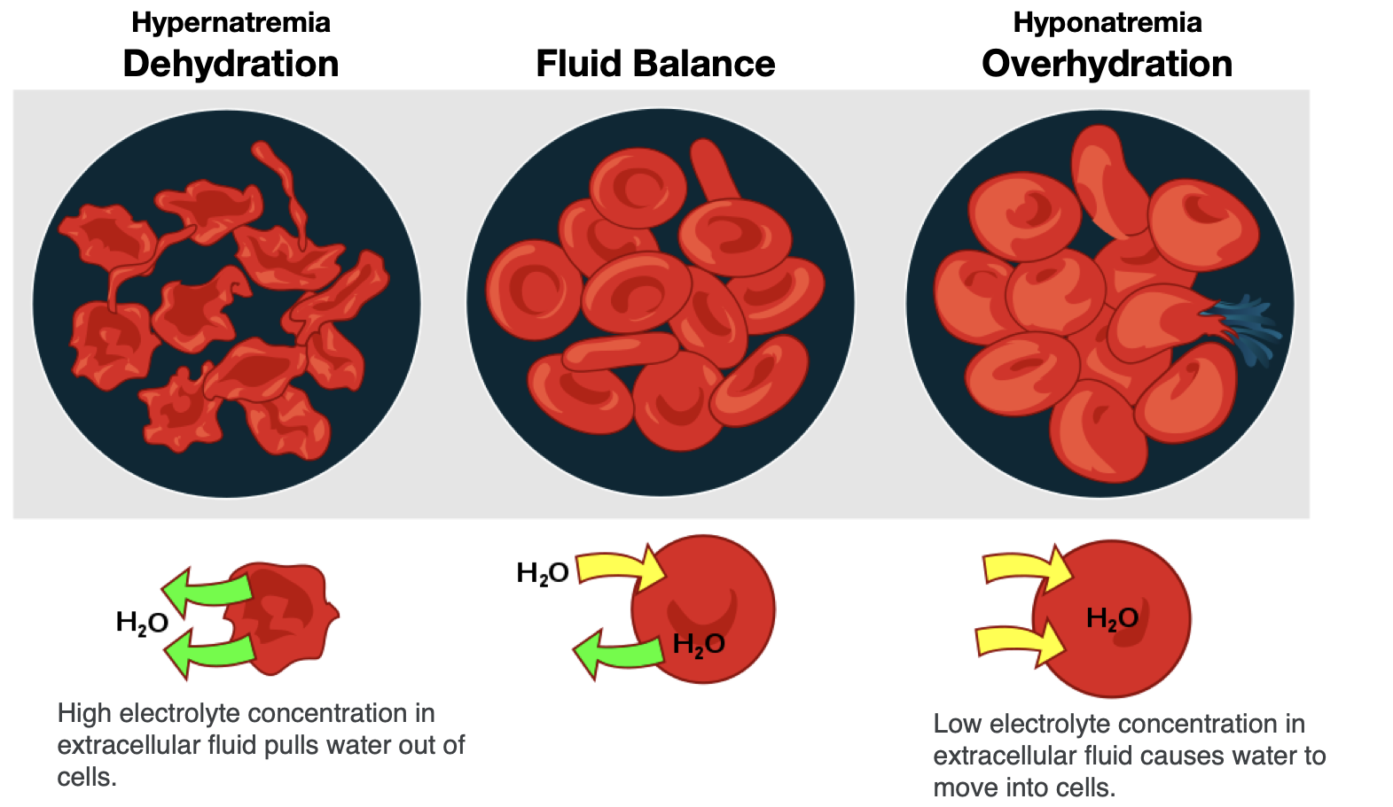 Three different hydration states are shown with the cell. With dehydration, the concentration of electrolytes becomes greater outside of cells, leading to water leaving cells and making them shrink. In fluid balance, electrolyte concentrations are equal inside and outside the cells, so water is in balance, too. During overhydration, electrolyte concentrations are low outside the cell relative to inside the cell (like in the situation of hyponatremia), so water moves into the cells, making them swell.