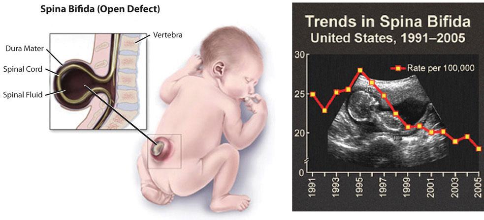 An image on the left shows an illustration of an infant on its stomach with an open defect on its spine, leaving the spinal cord exposed. A chart on the right shows how cases of neural tube defects in the U.S. have declined since the FDA mandated fortification of cereals and grain products with folic acid.