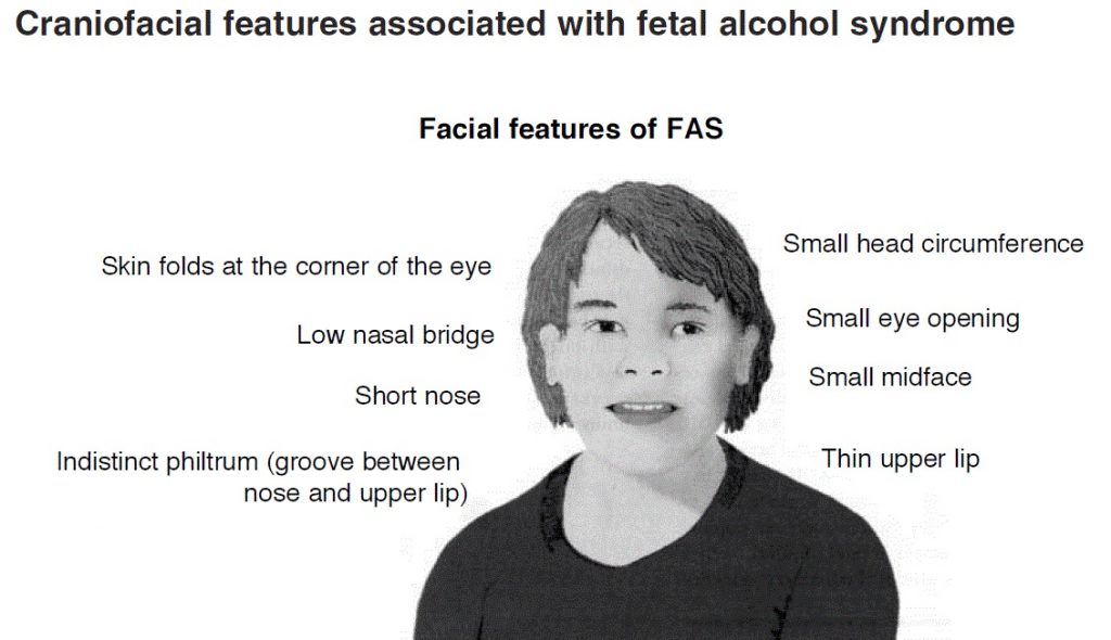 A black-and-white image shows a picture of a child with the facial features of fetal alcohol syndrome labeled: skin folds at the corner of the eye; low nasal bridge; short nose; indistinct philtrum (groove between nose and upper lip); small head circumference; small eye opening; small midface; and thin upper lip.