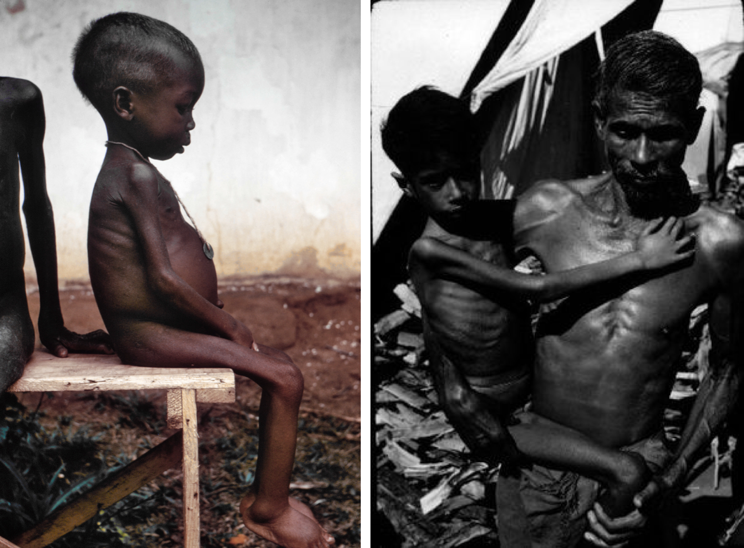 Two photos show children suffering from protein energy malnutrition. On the left is a child with kwashiorkor, showing the hallmark swollen belly. On the right is a child with marasmus, showing very thin limbs and visible ribs, no swollen belly.