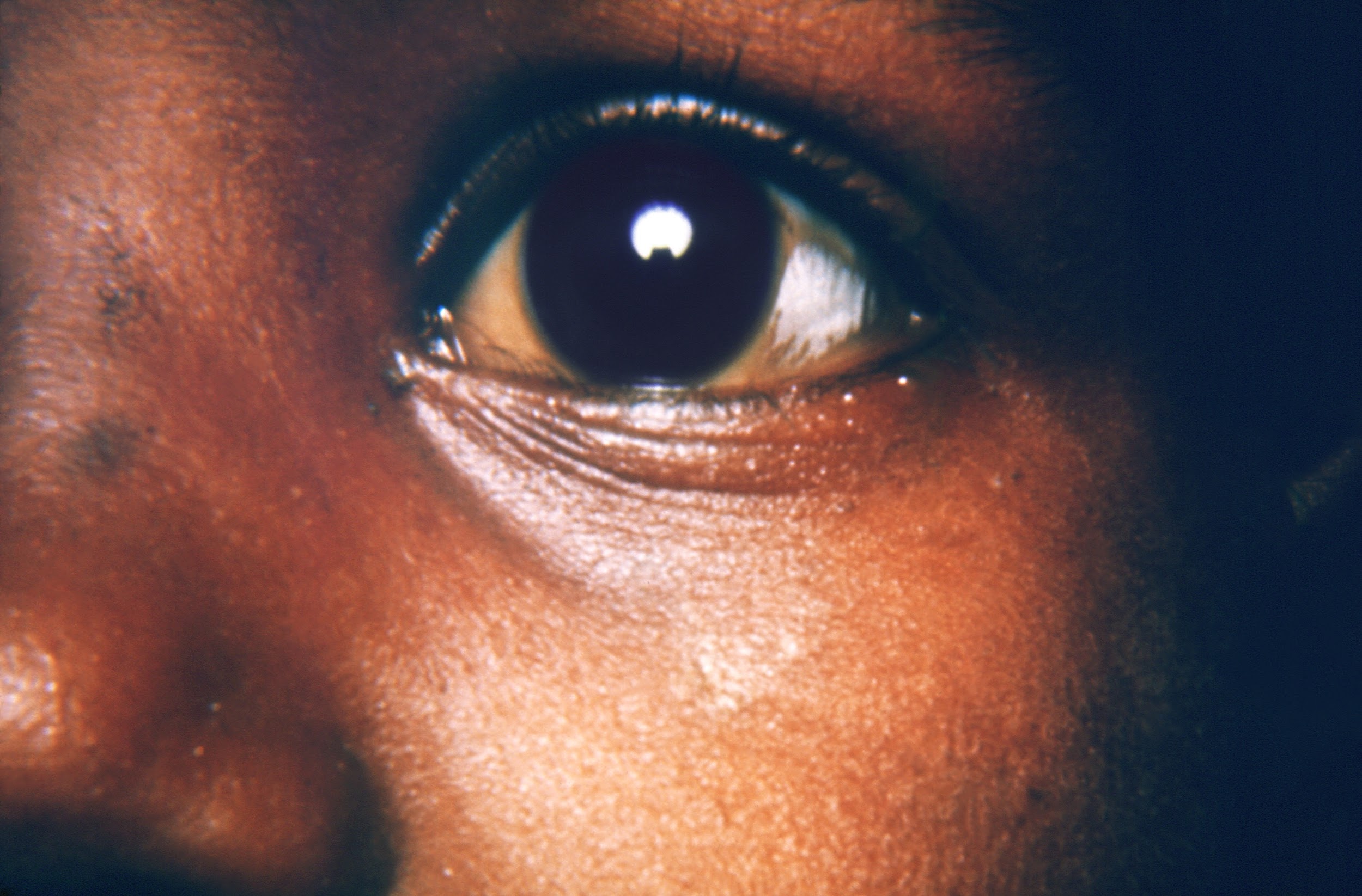A photo shows the eye of a child with xerophthalmia. The surface of the eye is subtly but visible clouded.