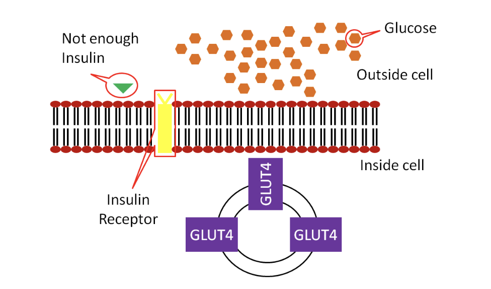 Schematic showing that in type 1 diabetes, the pancreas does not make enough insulin, so glucose transporters (GLUT-4) do not open on the cell membrane, and glucose is stuck outside the cell.