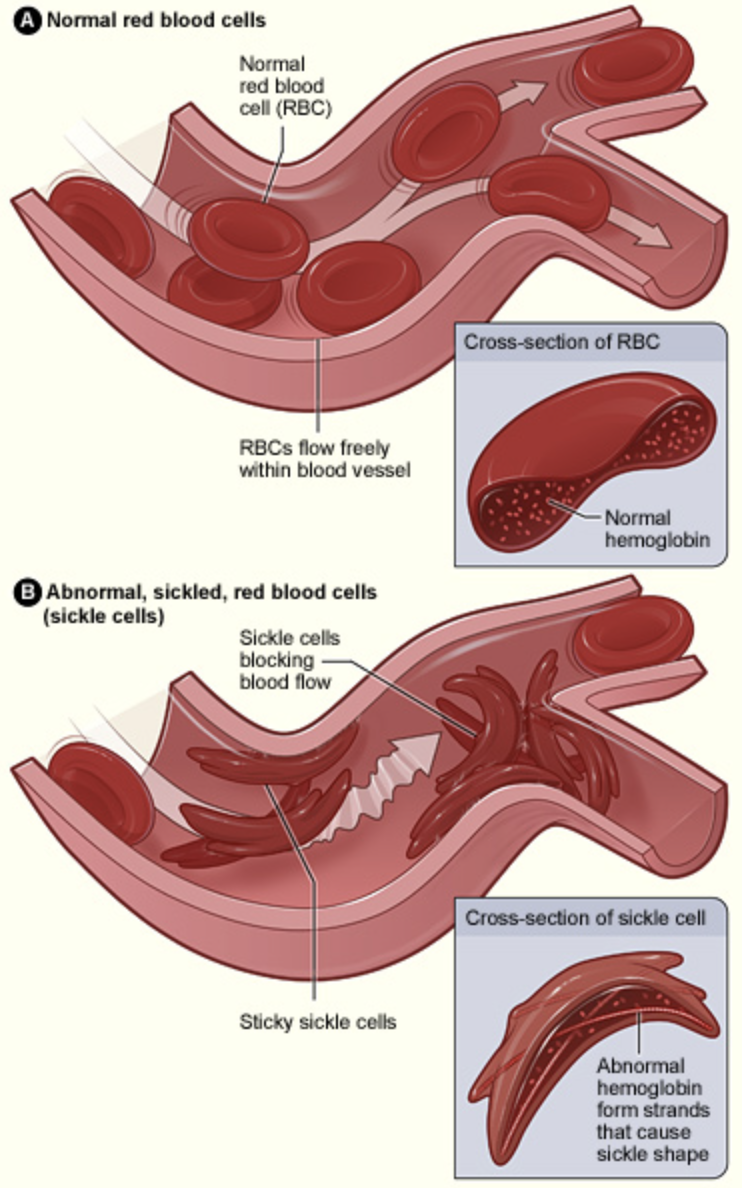Illustration shows the normal donut shaped red blood cells and how blood flow is not disrupted. Then compares this to the sickle cell red blood cells that look like crescents, and how these can block blood flow.