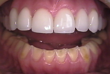This photo shows an open mouth with both the upper teeth and lower teeth in view. The lower teeth show erosion caused by bulimia. For comparison, the upper teeth were restored with porcelain veneers.