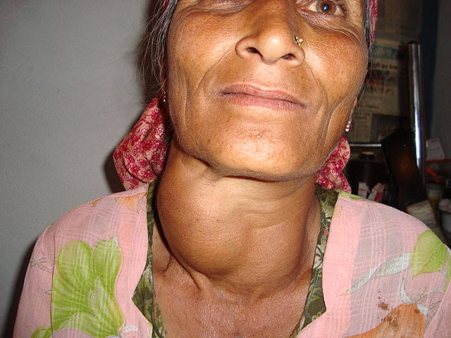 A picture of an Indian women's neck showing a large goiter.