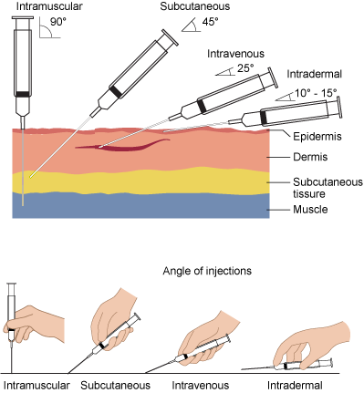 diagram showing injection angles of four hypodermic syringes