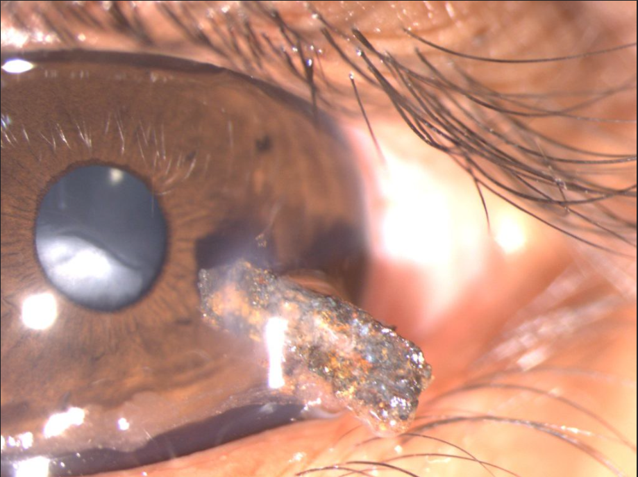 A photo of a cornea punctured by a shard of metal.