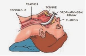 Anatomy of inserted OPA adjunct relative to the esophagus, trachea, tongue and pharynx.