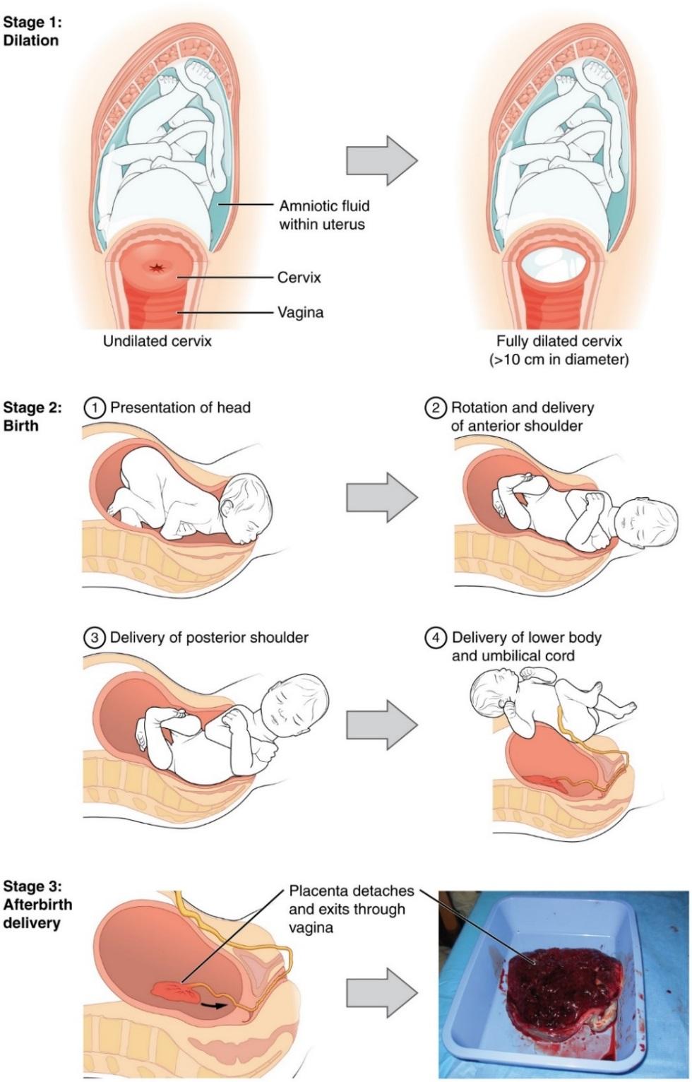 Stage 2, full dilation and expulsion of the newborn
