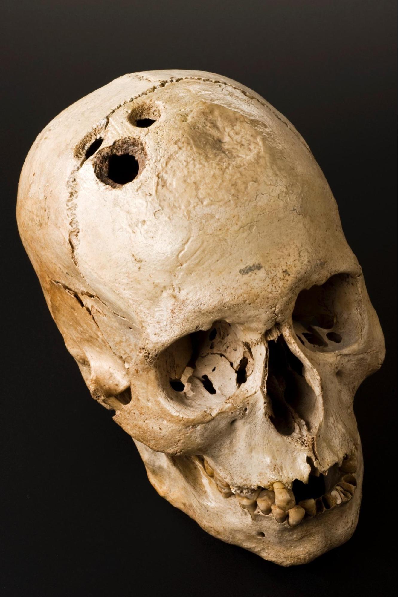 A trephined skull with 3 holes on the top.