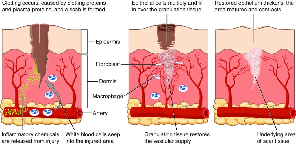 Stages of wound healing: hemostasis, inflammation, proliferation, remodeling.