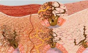 3D Cross-section showing skin tone becoming darker due to the production of more melanin to overcome the damage of melanin caused by sun tanning
