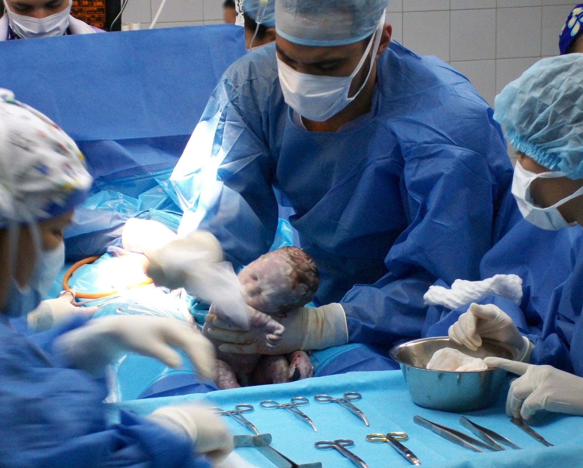 A baby is delivered via C-section by a male healthcare provider. Several other healthcare providers surround the area ready to assist with tools and implements.