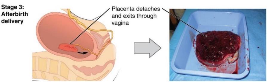 A cross-section view of the uterus with the placenta and a photo of the delivered placenta.