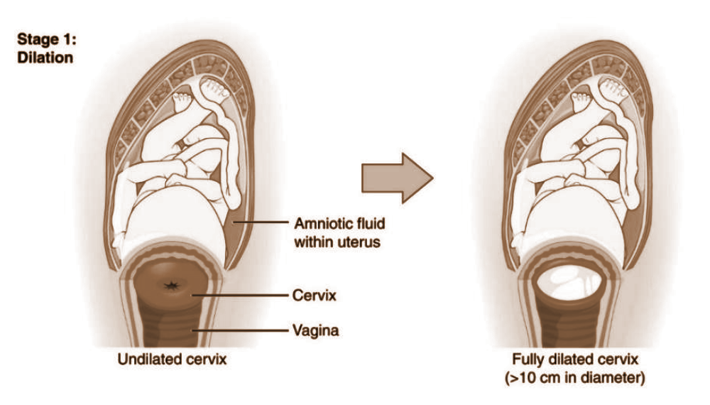 A cross-sectional view comparing undilated and fully dilated cervix during Stage 1 of childbirth.