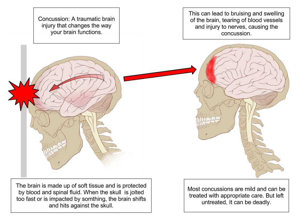 First image: A human skull moving forward and stopping abruptly upon impact with a solid wall. A cutaway shows the brain continuing to move forward and impacting the front of the skull. Second image: The same skull with cutaway and injured area on the frontal lobe of the brain highlighted.