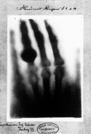 Blurry black and white x-ray of a hand