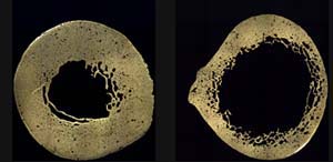 The femur cross-section on right shows significant reduction in bone thickness and reduced density near the inner surface.