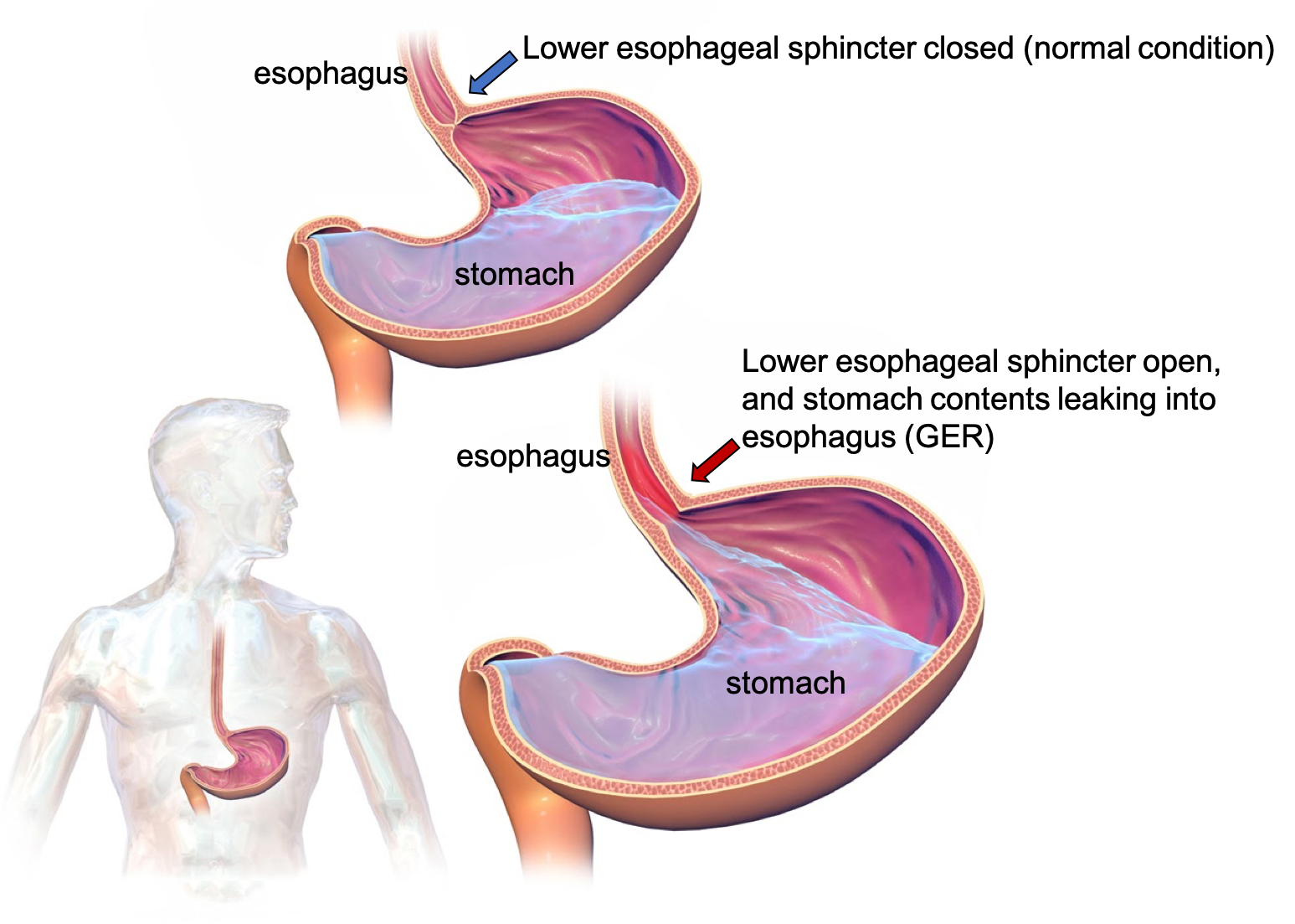 Disorders of the GI Tract Nutrition Science and Everyday