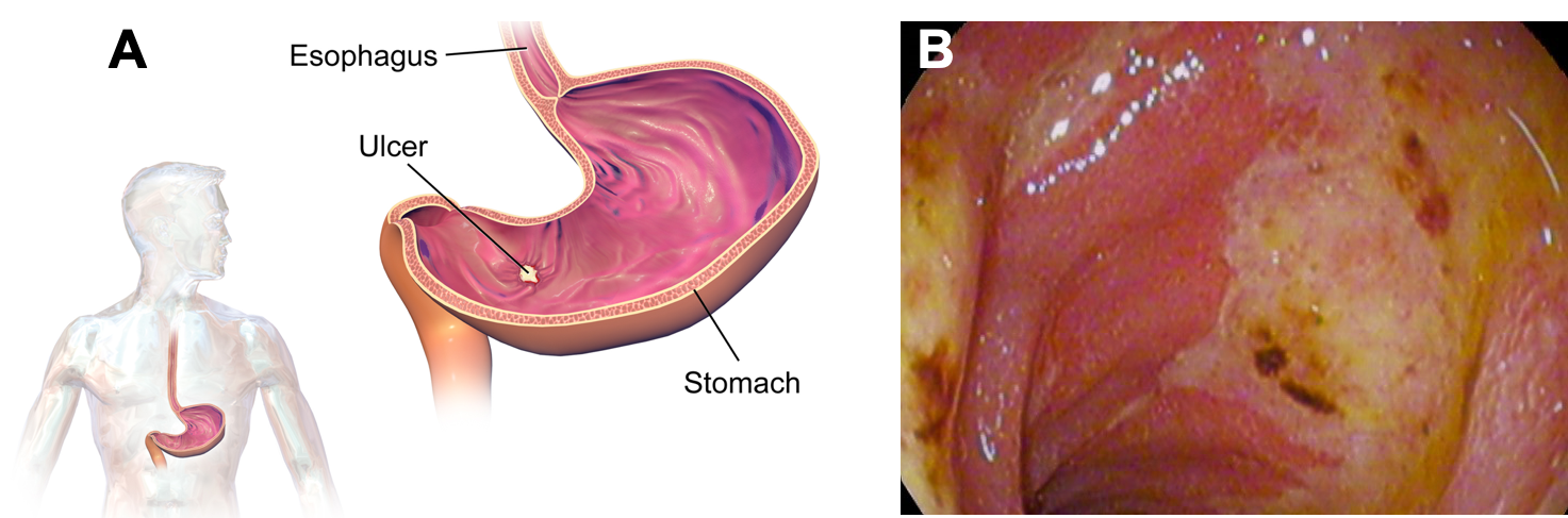 Disorders of the GI Tract Nutrition Science and Everyday