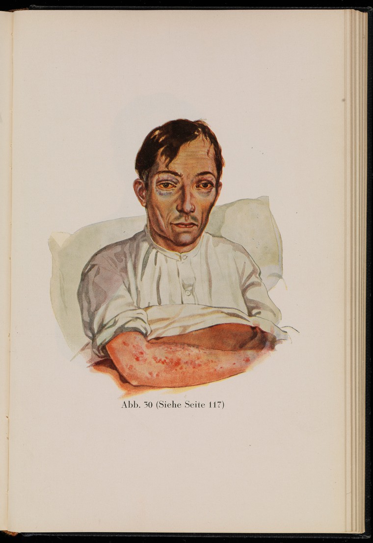 This drawing of a patient with scurvy, from a 1929 medical text, shows a man sitting in bed, with sunken eyes ringed with dark circles and visible lesions on the skin of his arm.